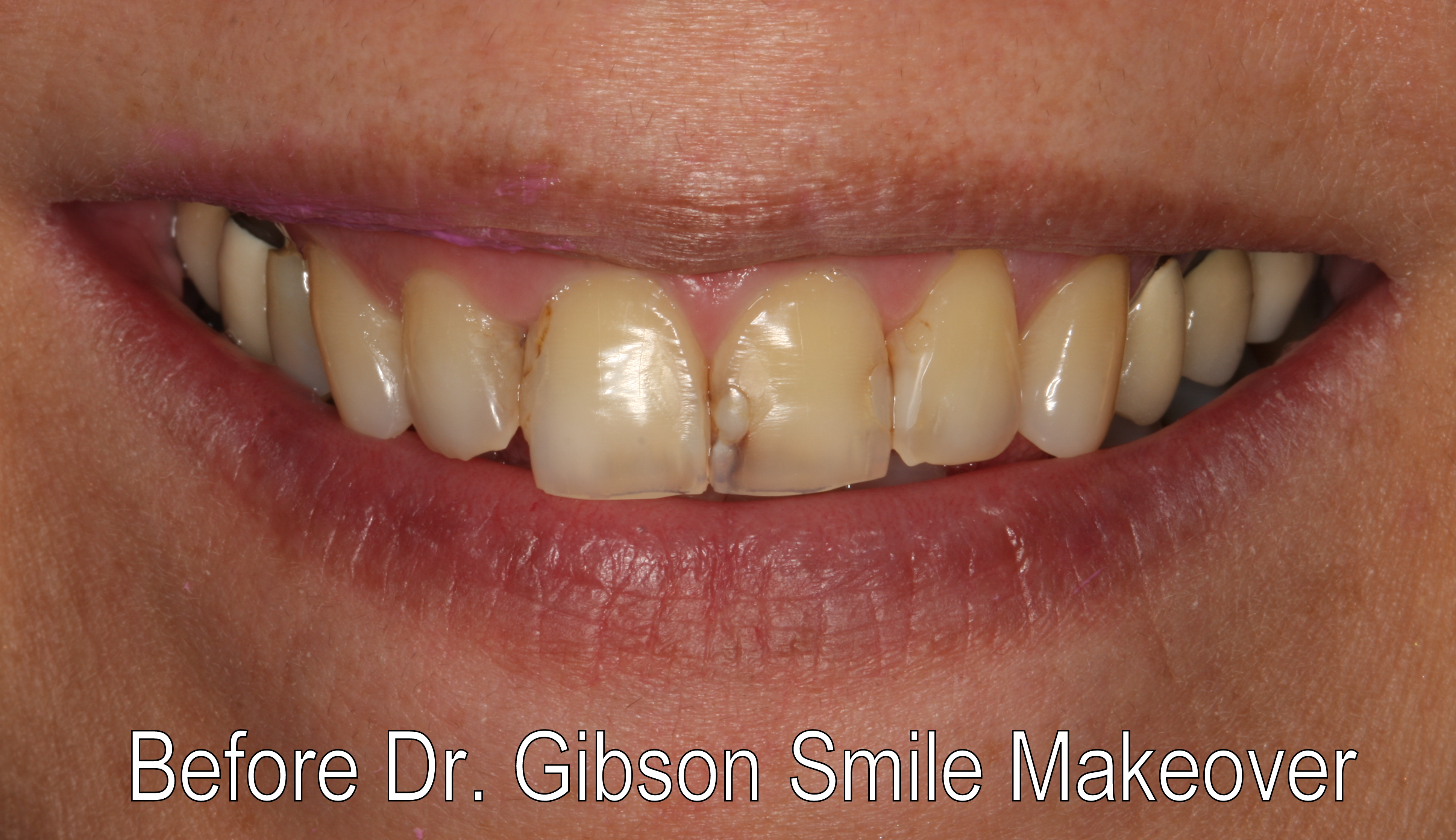 Smiles By Dr. Gibson Smile Makeover 5