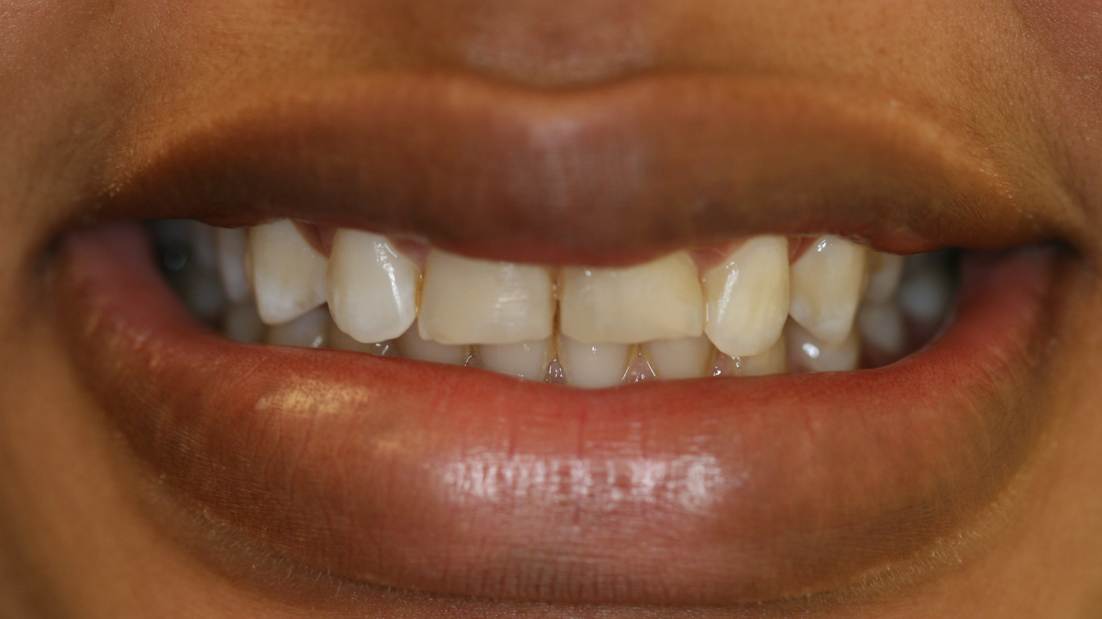Smiles By Dr. Gibson Smile Makeover 8