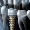 Dental Implants Part I