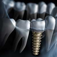 Surgery / Dental Implants